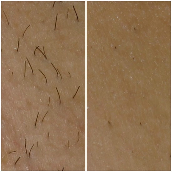 PHOTO SOURCE: me Power - Before/After photos of a female's under arm after using me Smooth for a few weeks. 